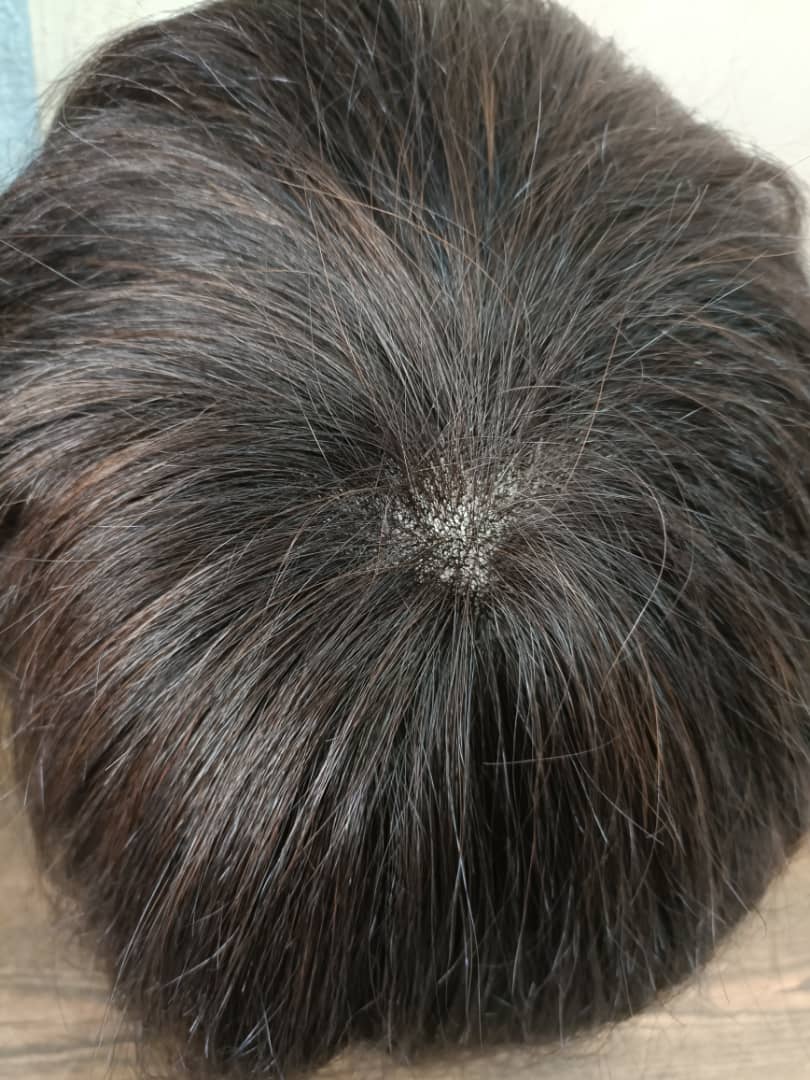 پروتز مو طبیعی بالای سر مردانه (کد:8025)